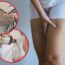 remedios caseros para eliminar la celulitis